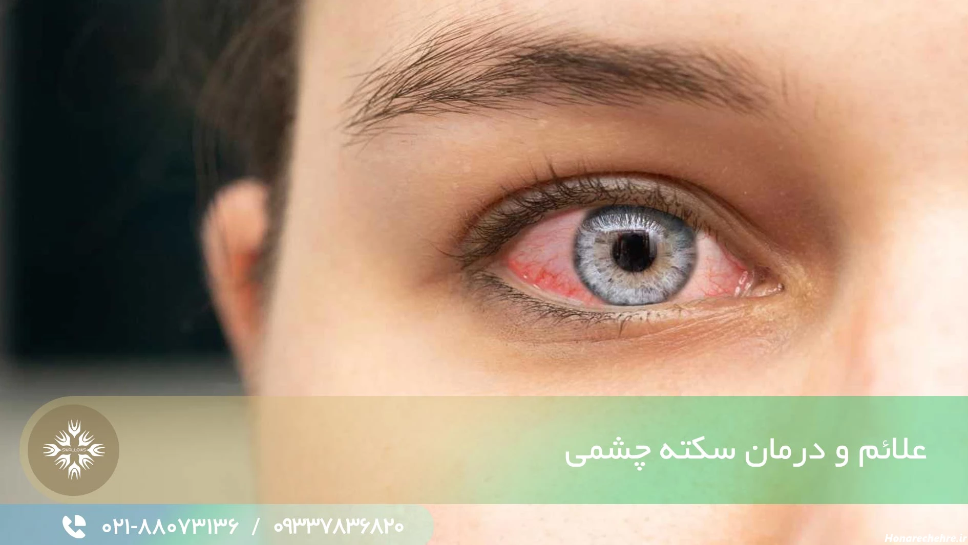 علائم و درمان سکته چشمی - کلینیک یادمان