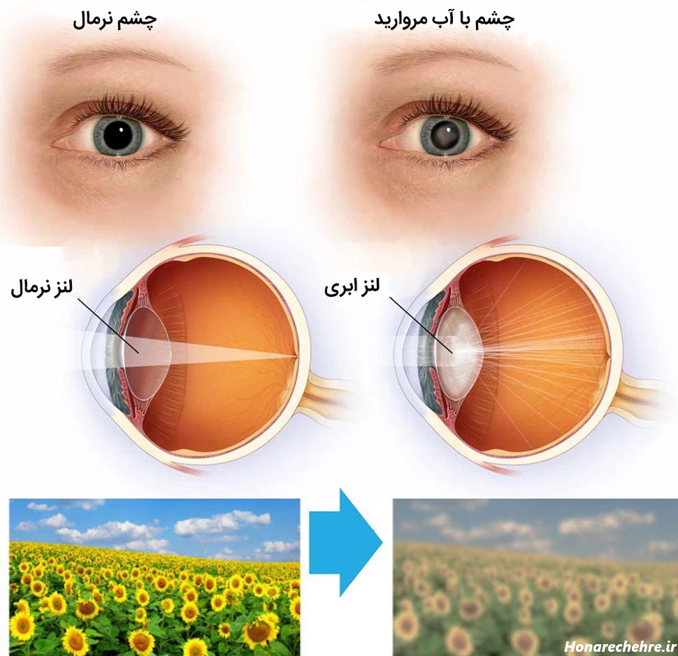 آب مروارید چشم چیست؟ علل ایجاد و روش های درمان کاتاراکت