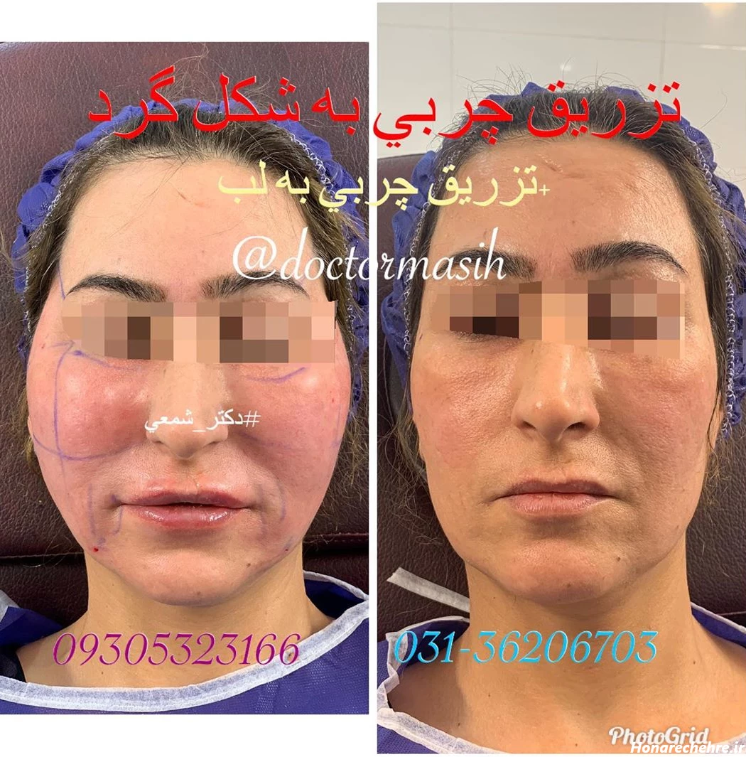 تزریق چربی - تزریق چربی اصفهان