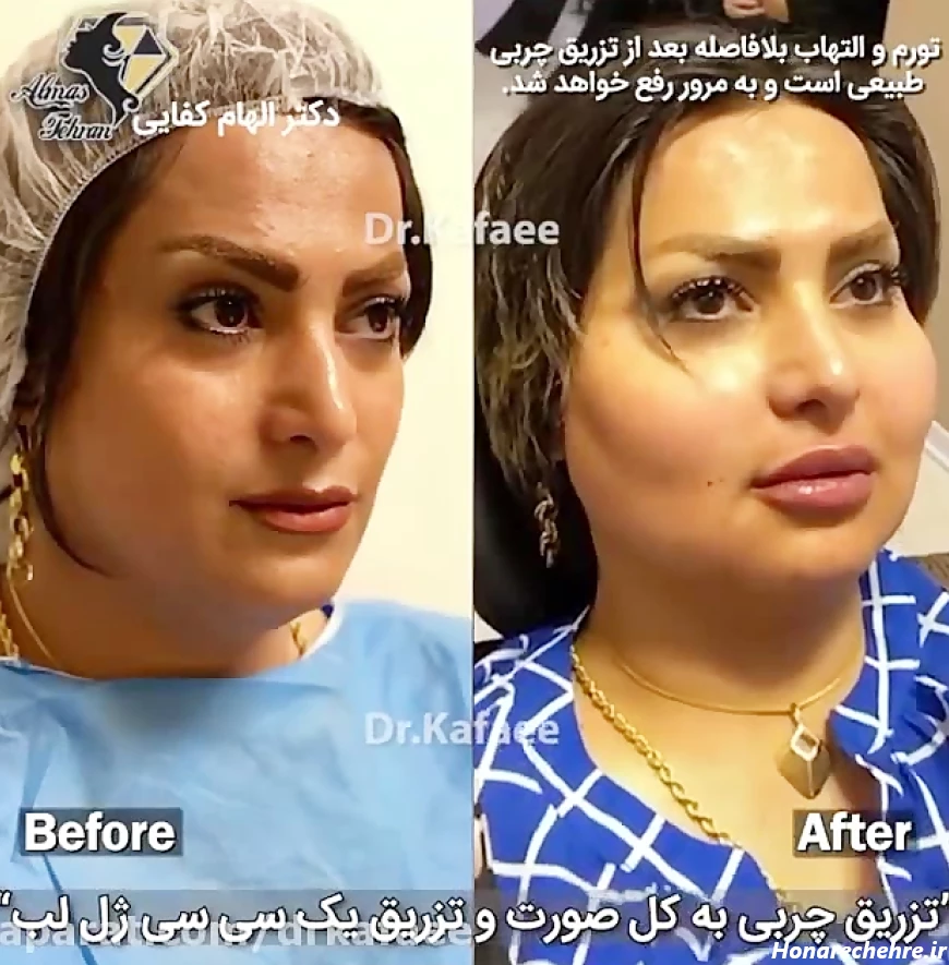 تزریق چربی به کل صورت و تزریق ژل لب