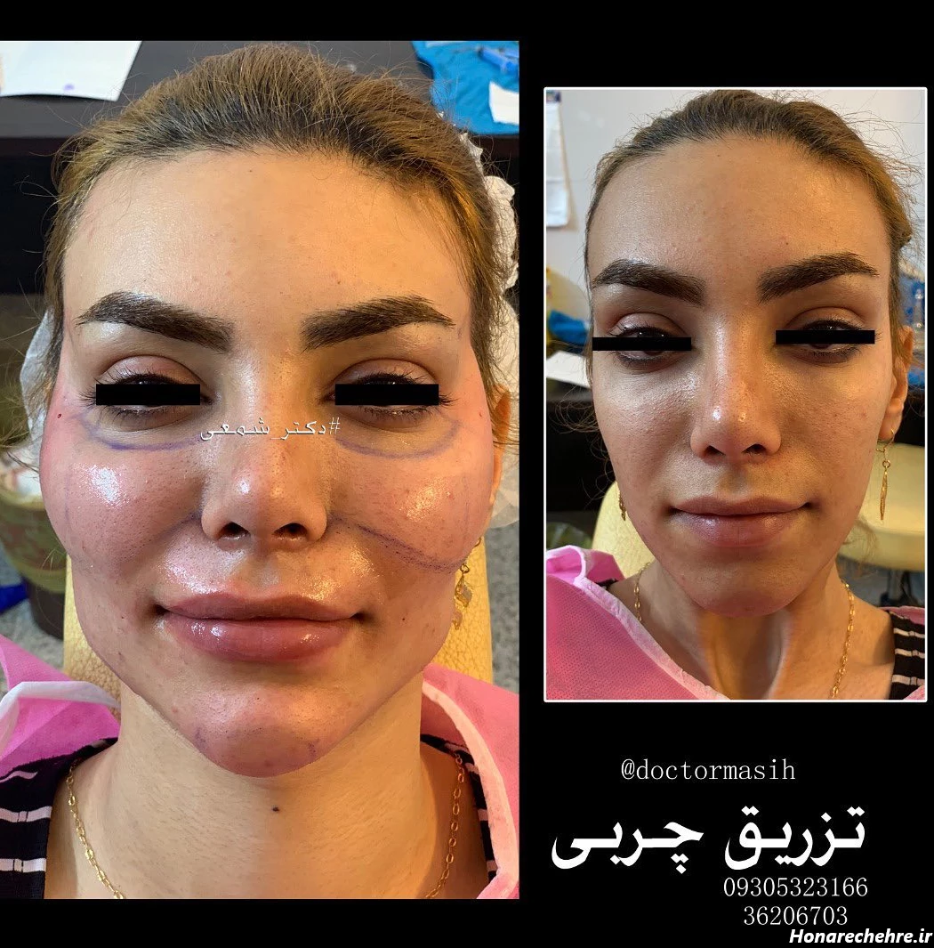 تزریق چربی - تزریق چربی اصفهان