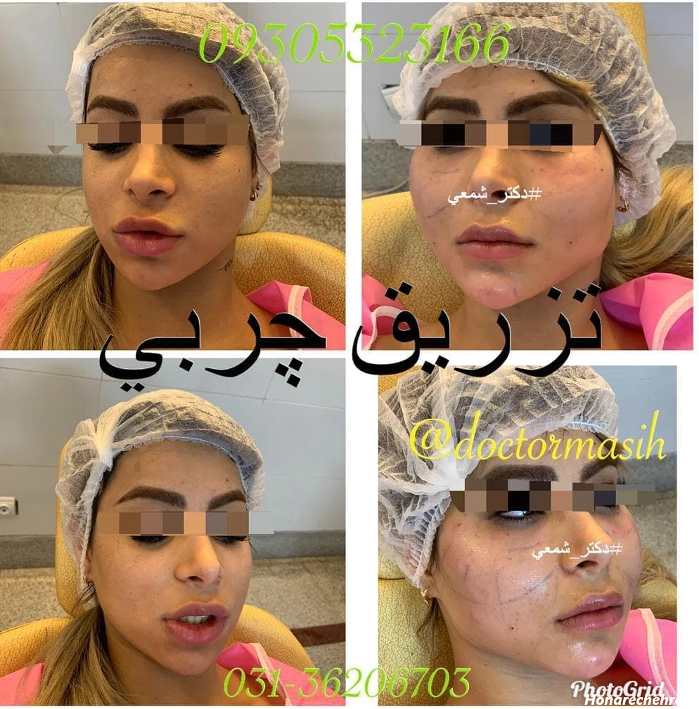 تزریق چربی - تزریق چربی اصفهان