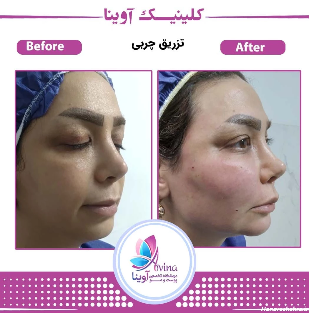 تزریق چربی - کلینیک زیبایی آوینا❤️|مجهزترین کلینیک زیبایی ...