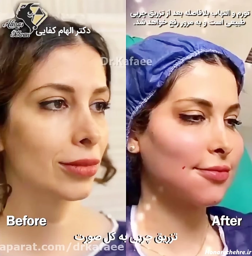 قبل و بلافاصله بعد از تزریق چربی به کل صورت