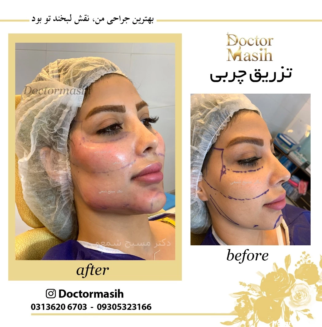 تزریق چربی - تزریق چربی اصفهان