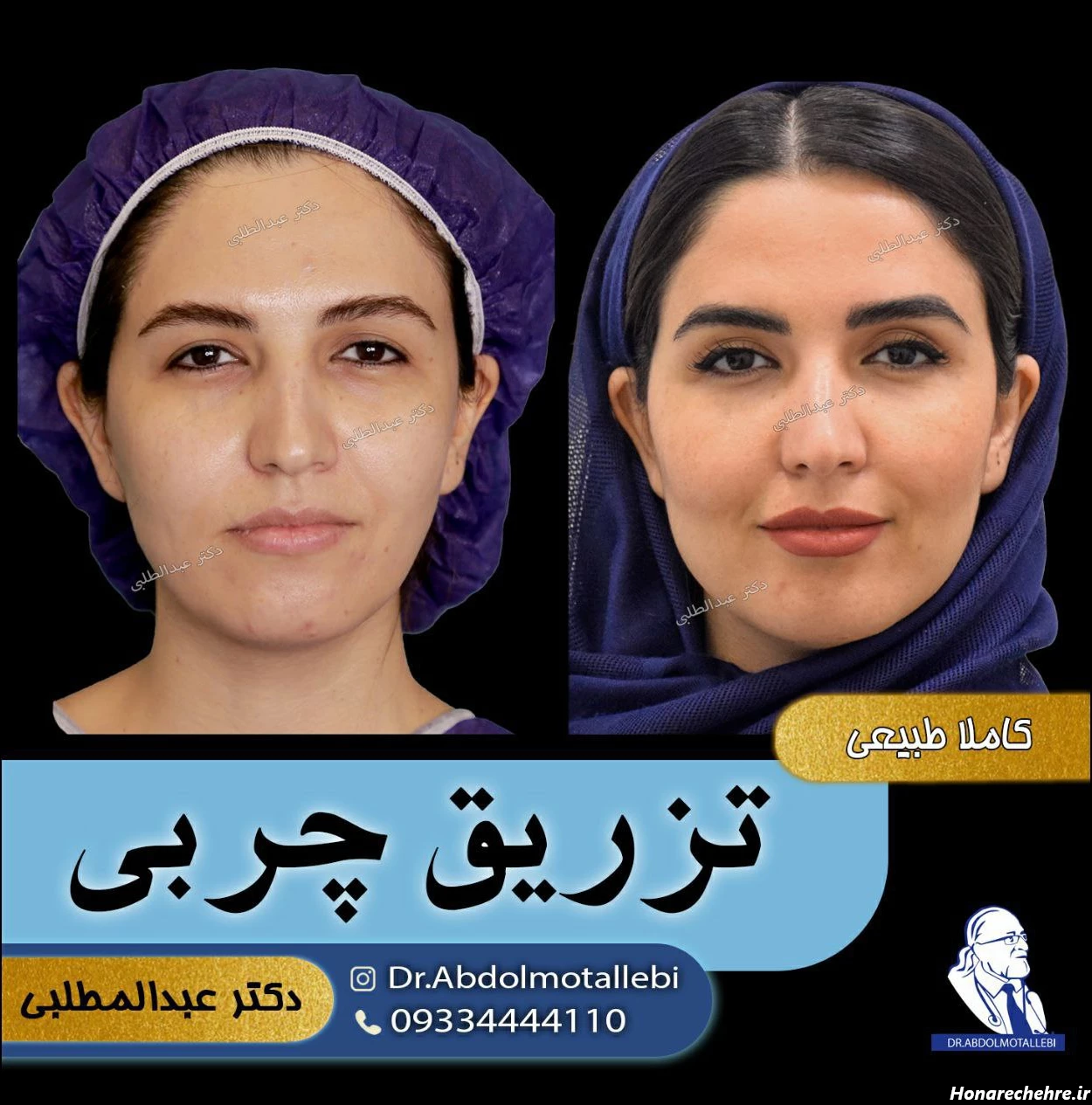 بهترین متخصص تزریق چربی به صورت در تهران کیست؟