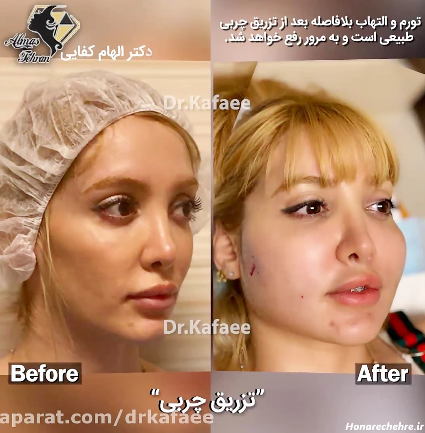 تزریق چربی به صورت
