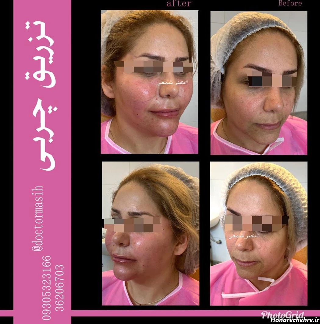 تزریق چربی - تزریق چربی اصفهان