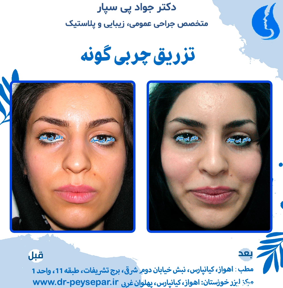 نمونه کارهای تزریق چربی - دکتر جواد پی سپار