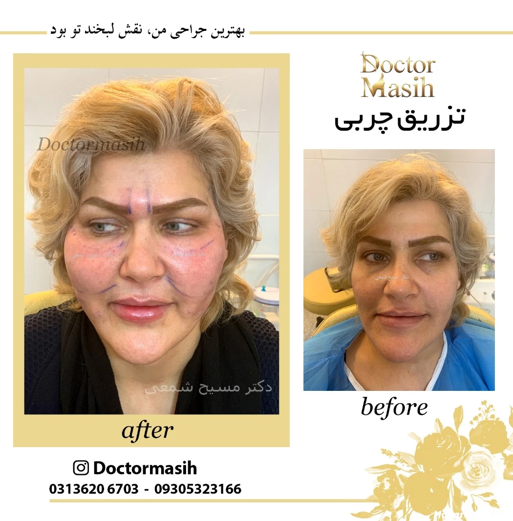 تزریق چربی مدل قلبی
