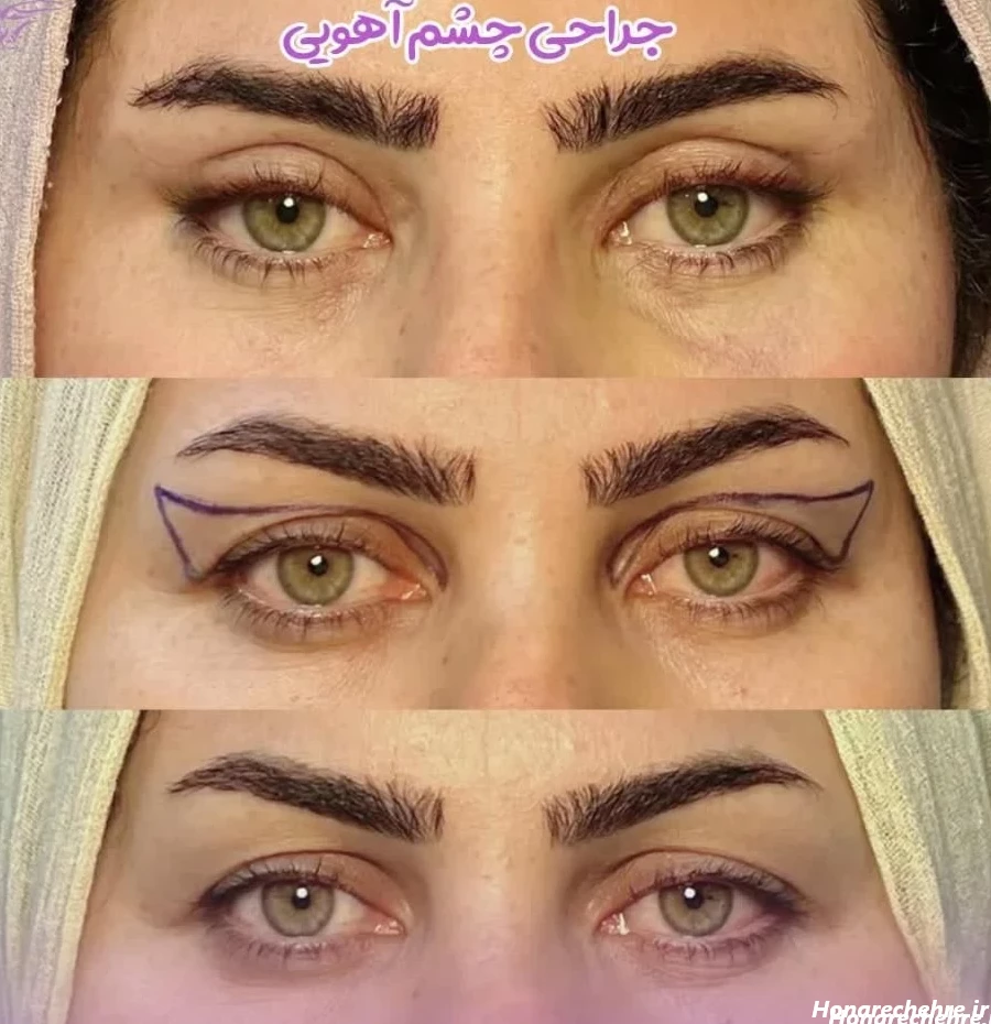 چشم آهویی انسان