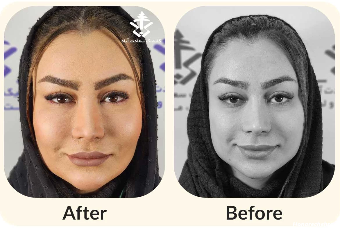 تزریق چربی ← همراه با مشاوره رایگان + نمونه کار قبل و بعد
