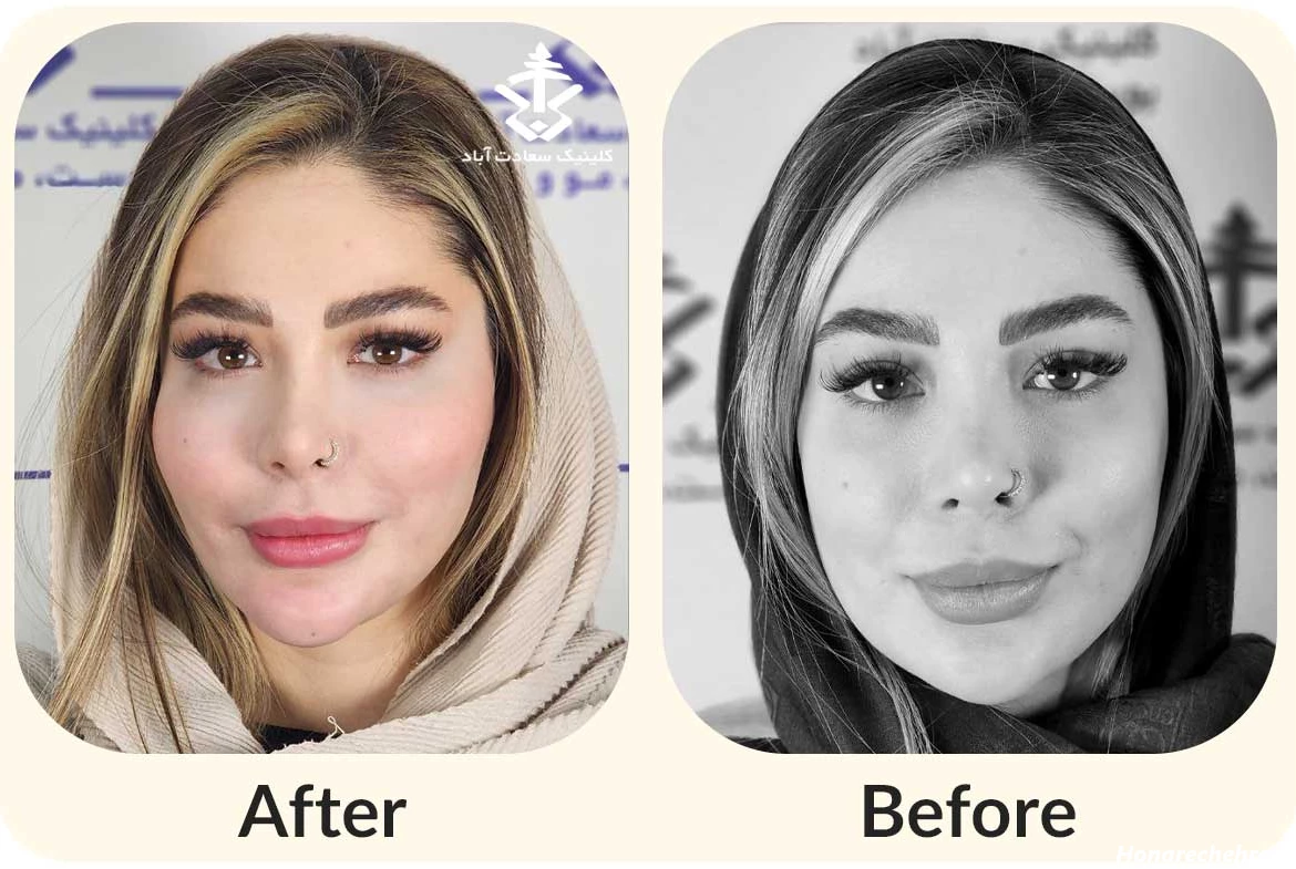 تزریق چربی