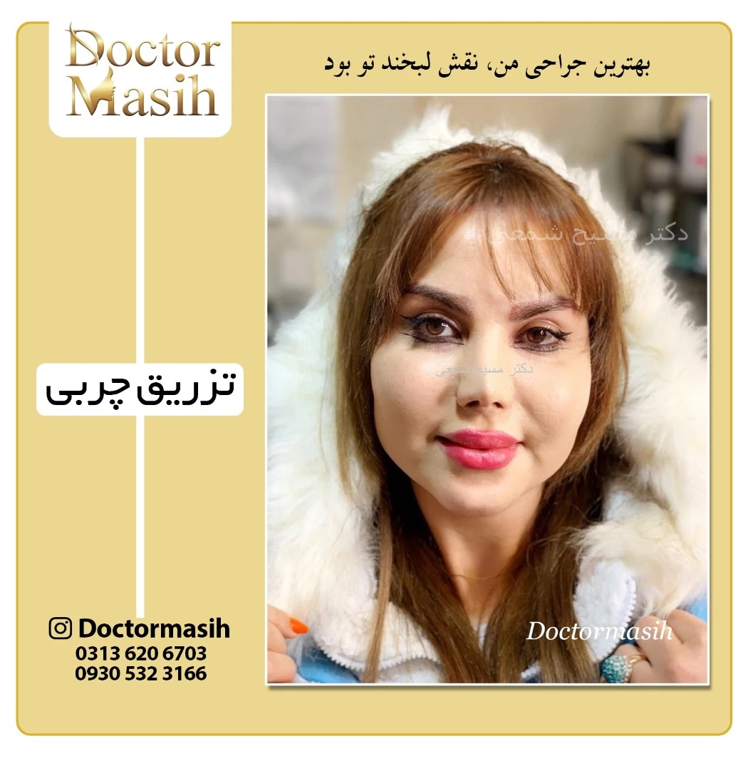 تزریق چربی اصفهان