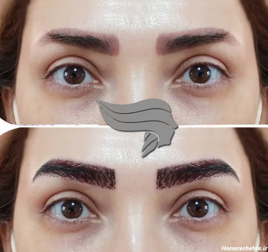 کاشت ابرو پهن دخترانه پرتراکم و طبیعی + عکس در بهترین کلینیک ...
