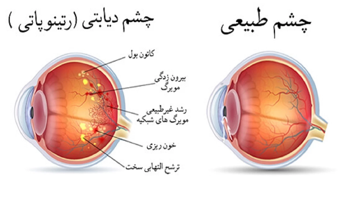 22 عکس از شبکیه چشم سالم و زیبایی آن